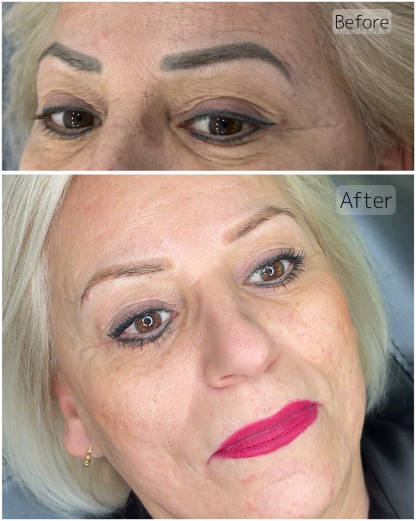 Voor en na resultaat van het neutraliseren van oude PMU wenkbrauwen als voorbereiding op een nieuwe behandeling.